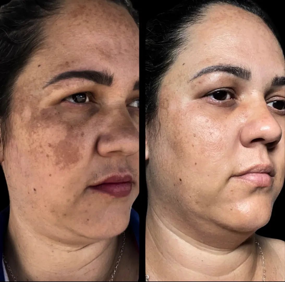 Resultado de tratamento 4